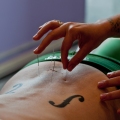 Acupuncture – Alternative ...