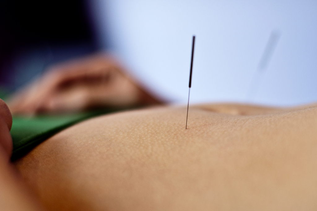 acupuncture1 Acupuncture   Alternative Medicine