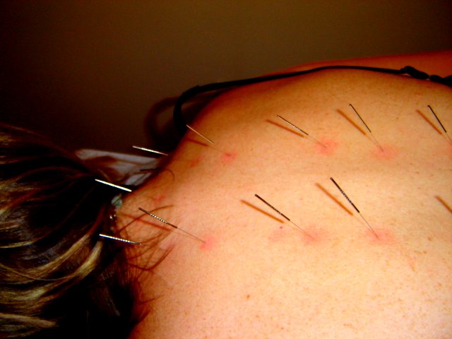 acupuncture8 Acupuncture   Alternative Medicine